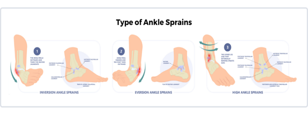 Types of Ankle Sprains